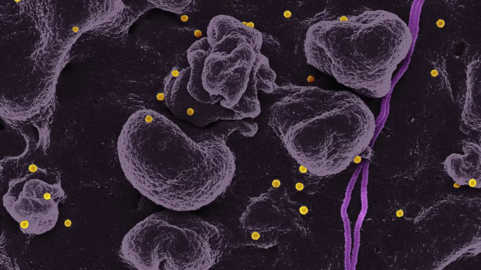 Low Platelets Symptoms: Causes, Signs & What to Do